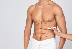 Mans Fit Torso With Surgical Lines On His Body Before Operation